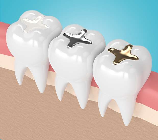 Oxnard Composite Fillings