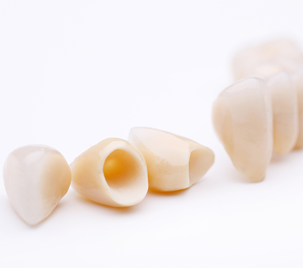 Oxnard Dental Crowns and Dental Bridges