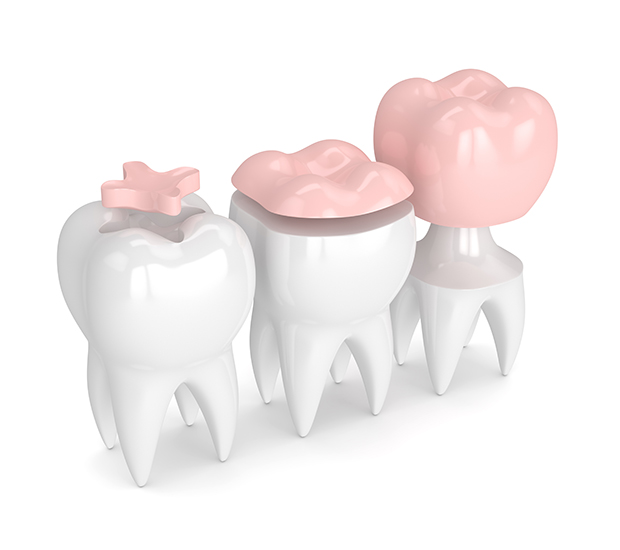 Oxnard Dental Inlays and Onlays